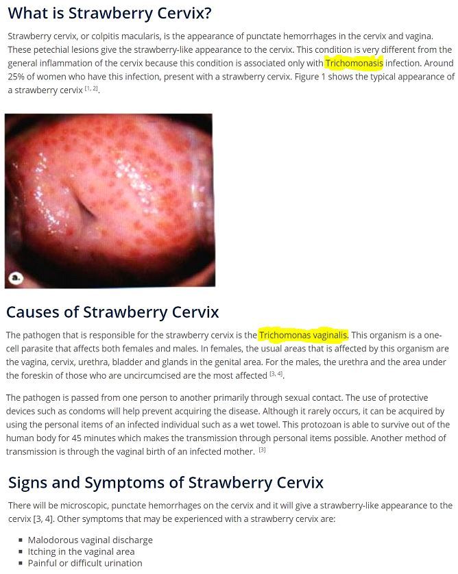 Trichomonas Vaginalis test + Candida albicans Test ( yeast infection