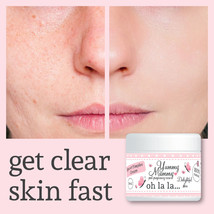 Yummy Mummy After Birth Spots & Pimples Cream Treatment Clear Complexion - $33.86