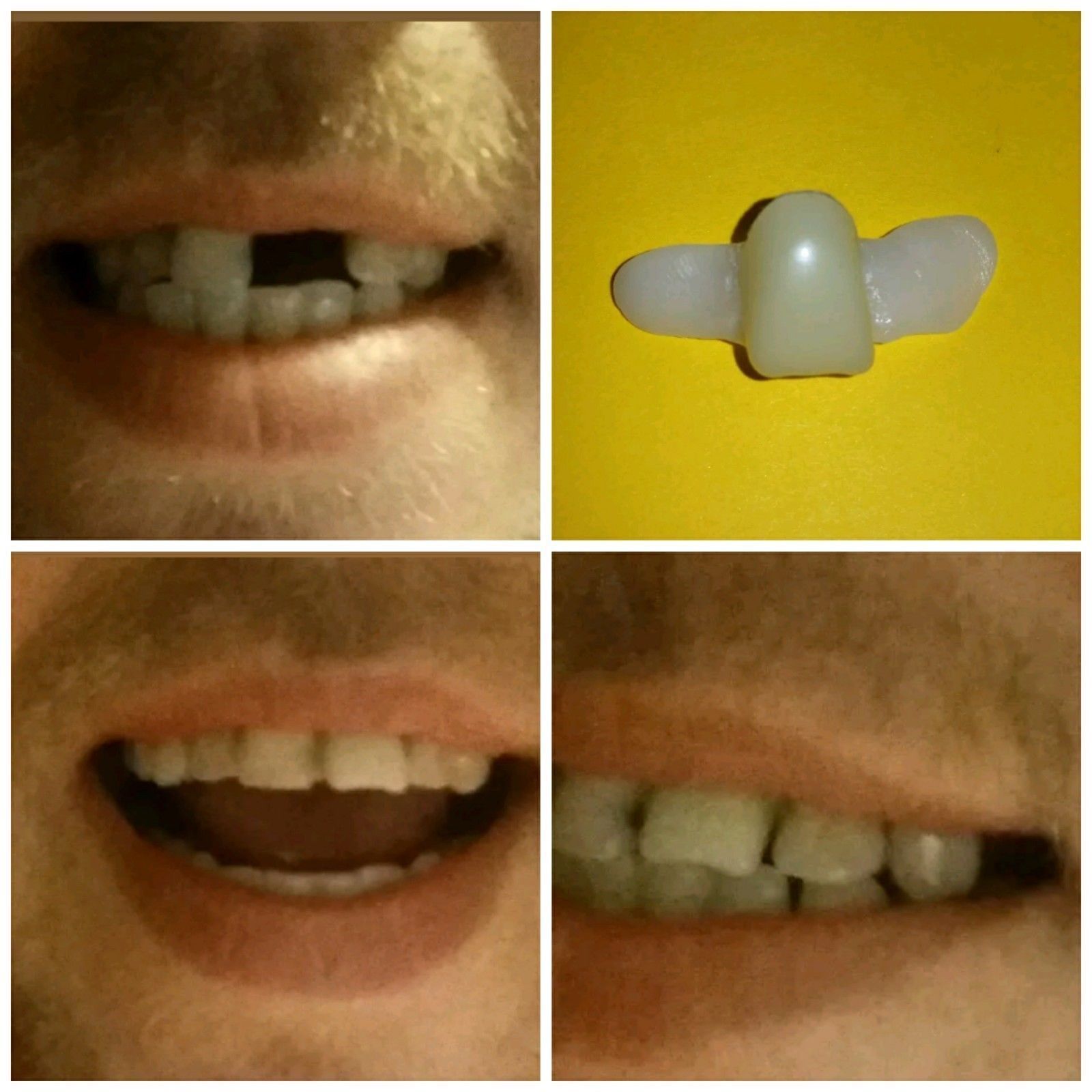 DIY Temporary Replacement Front Tooth Central Incisor Other Oral Care