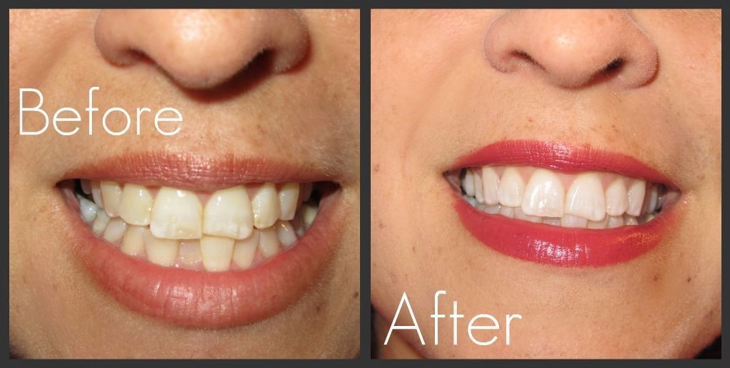 2 Boxes Crest 3D White Luxe Whitestrips Professional Effects Teeth