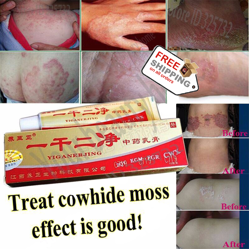 Psoriasis eczema ointment mint cream Suitable all skin diseases Safety