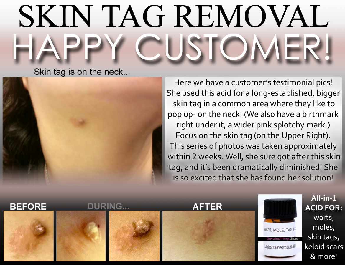 3 Day Peel For HPV Warts, Plantar Warts, Moles, Skin Tags, and Keloids