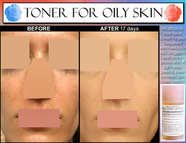ALCOHOL FREE HERBAL Toner For Oily Skin &amp; Acne with Salicylic Acid and L... - $31.99