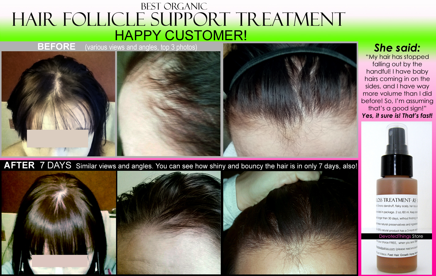 Best Organic Hair Loss Treatment And Hair And 50 Similar Items