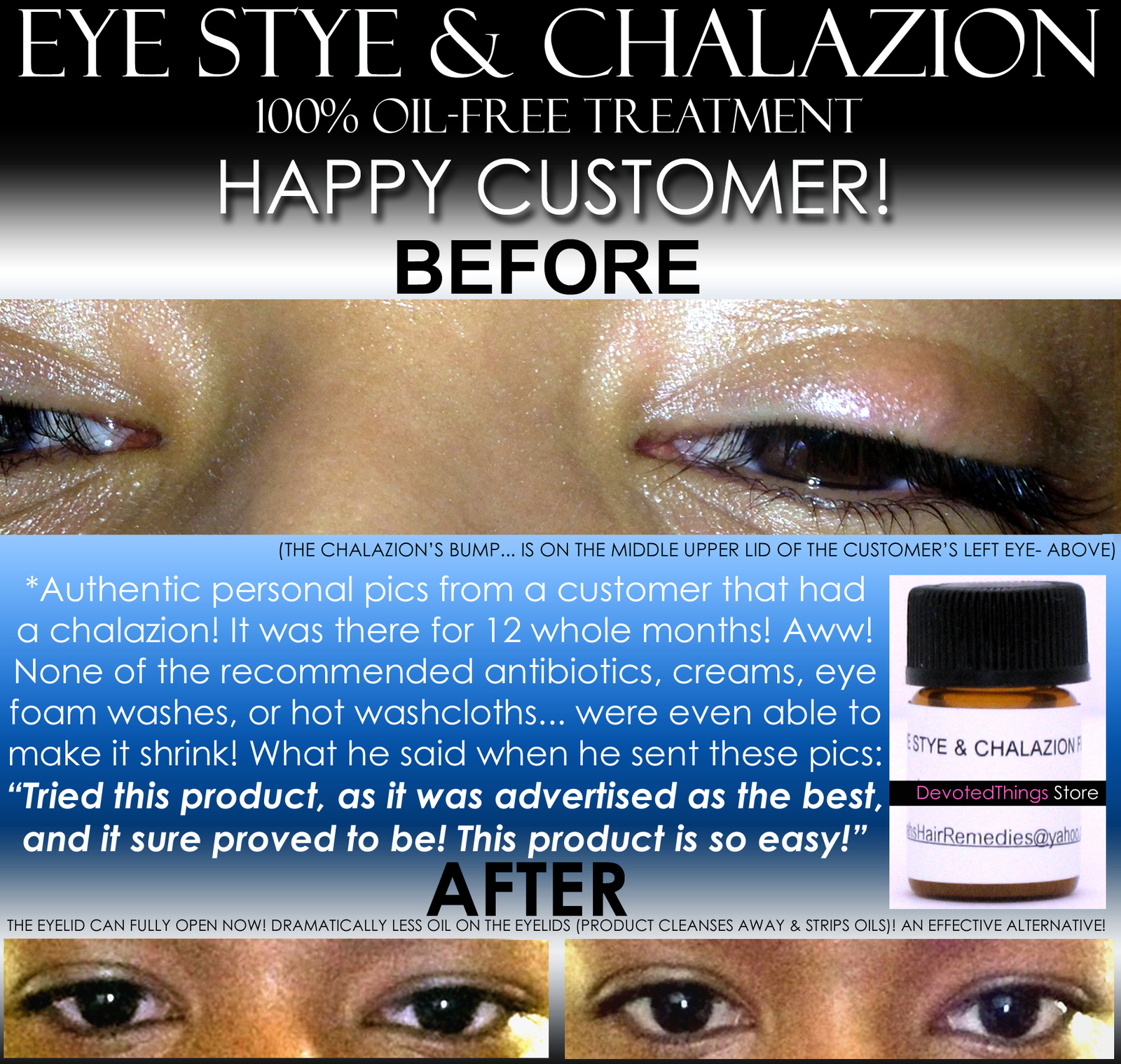 BEST Eye Stye Treatment and Chalazion and 50 similar items