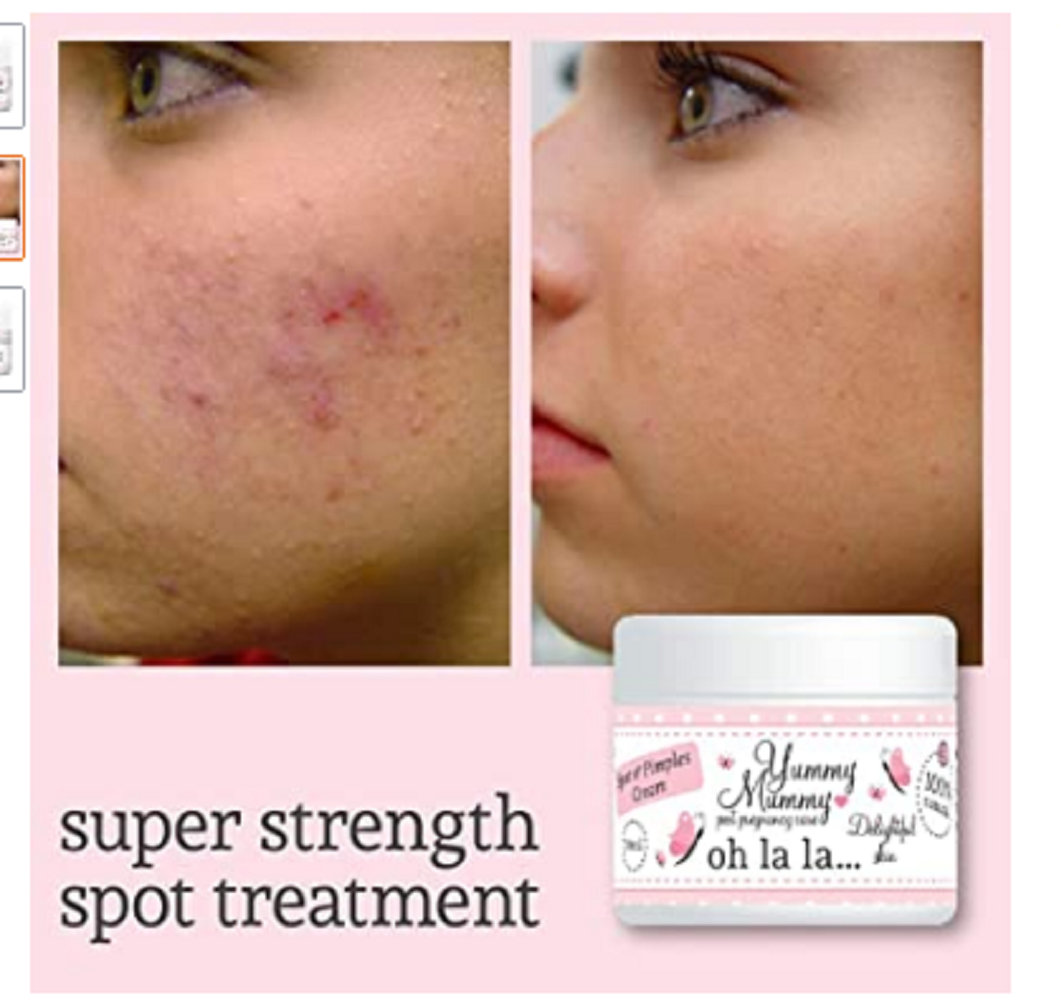 Yummy Mummy After Birth Spots And Pimples Cream Treatment Clear Complexion Acne And Blemish Control