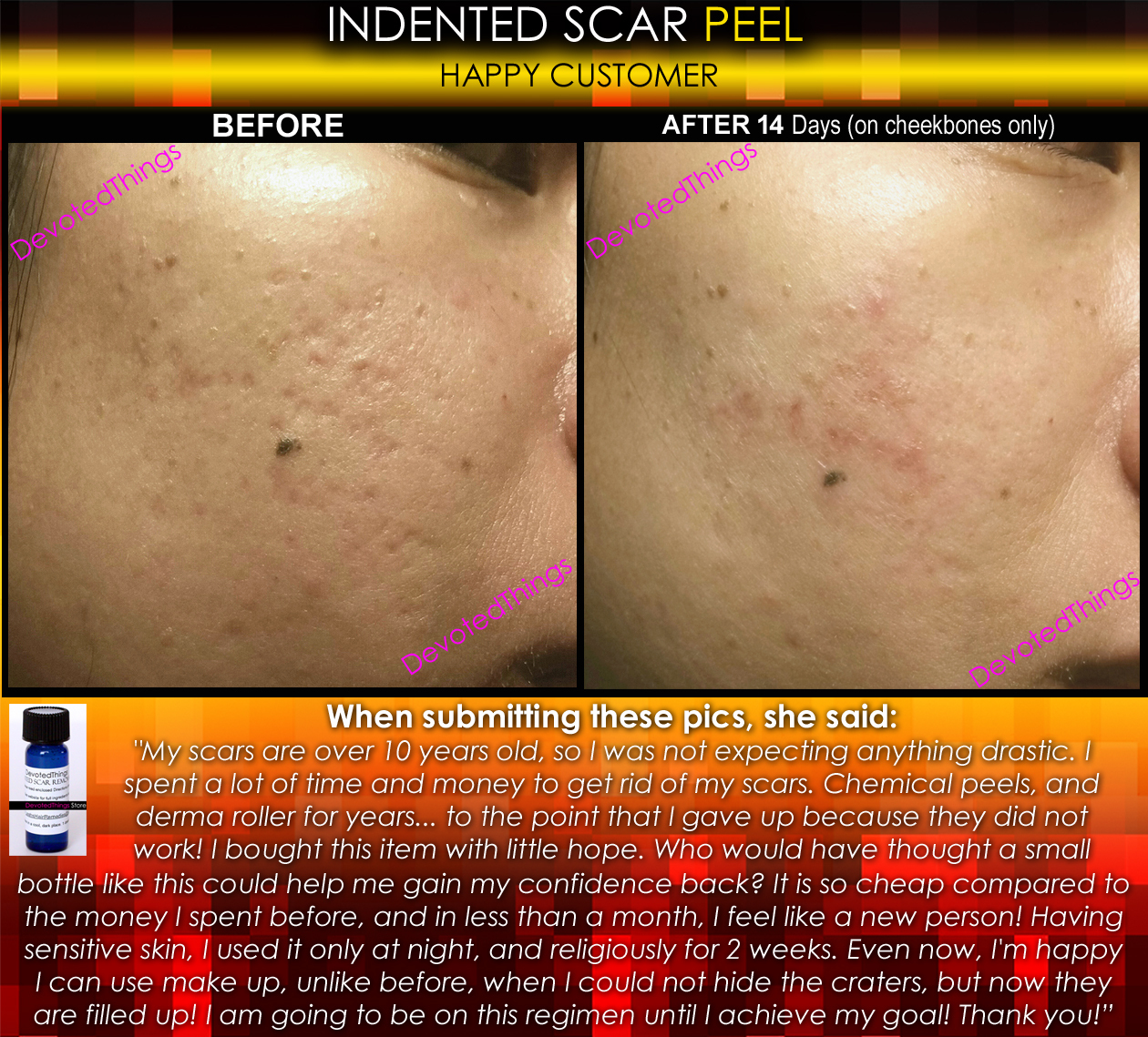 BEST Treatment for Indented Scars Acne Chicken Pox Pitted Scar Removal