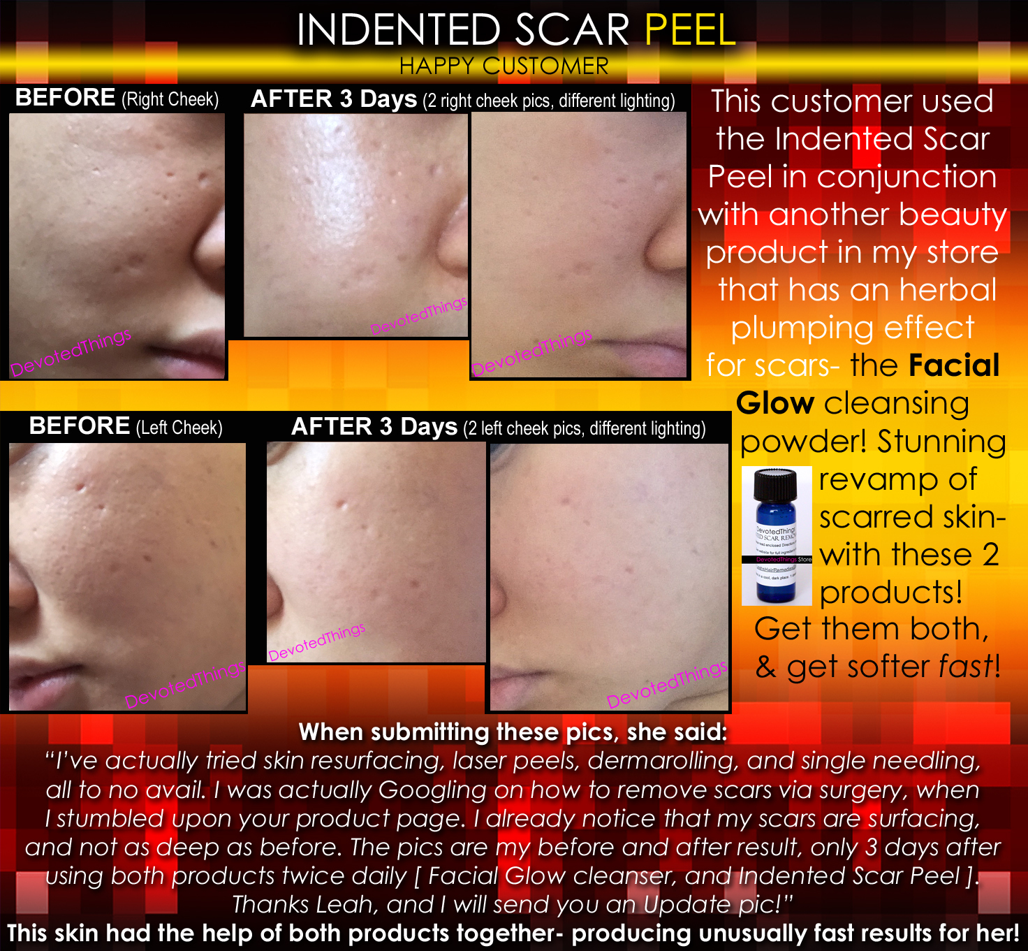 BEST Treatment for Indented Scars Acne Chicken Pox Pitted Scar Removal