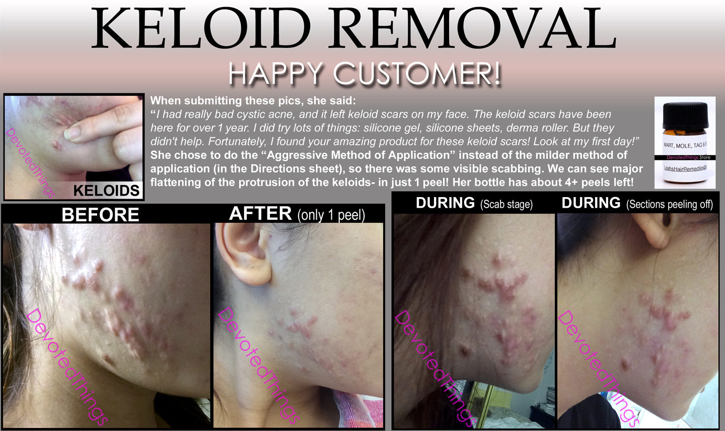 3 Day Peel For HPV Warts, Plantar Warts, Moles, Skin Tags, and Keloids
