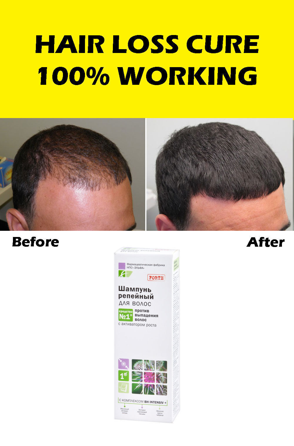 100 WORKS Anti Hair Loss Scalp Treatment INSTANT RESULTS Regrowth For
