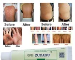 1piece zudaifu body psoriasis cream psoriasis ointment facial cleansing thumb155 crop