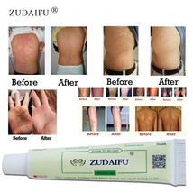 1piece zudaifu body psoriasis cream psoriasis ointment facial cleansing thumb200
