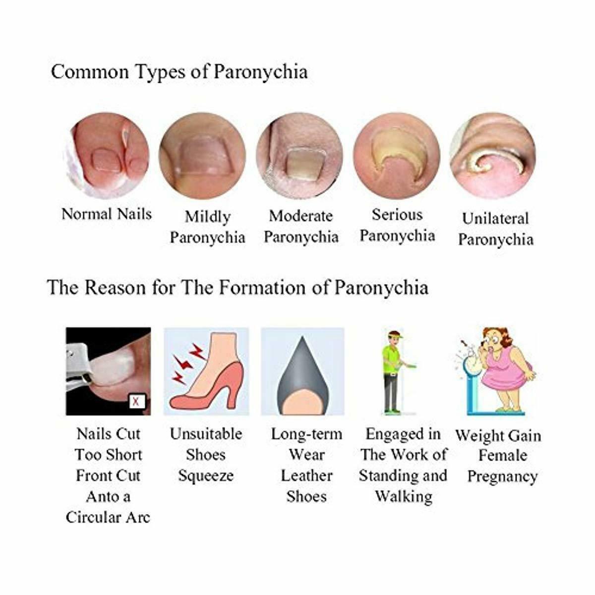 Professional Ingrown Pincer Toenail Correction Sticker Pedicure