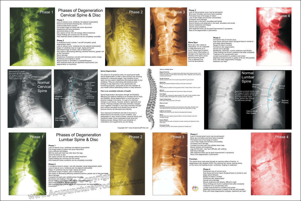 Vertebral Spinal Disc Degeneration Poster 24 X 36 Chiropractic Chart ...