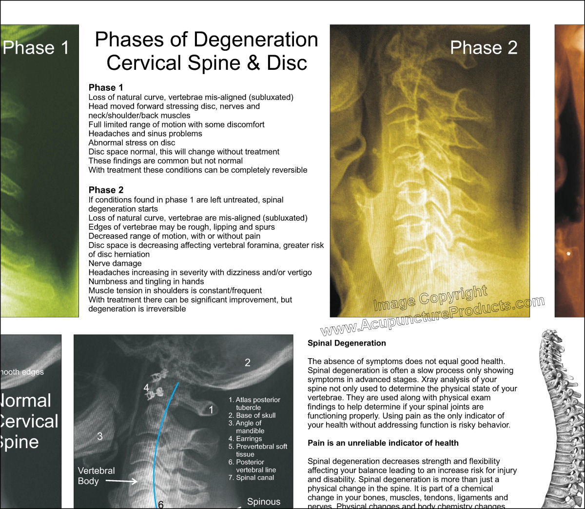 Vertebral Spinal Disc Degeneration Poster 24 X 36 Chiropractic Chart ...