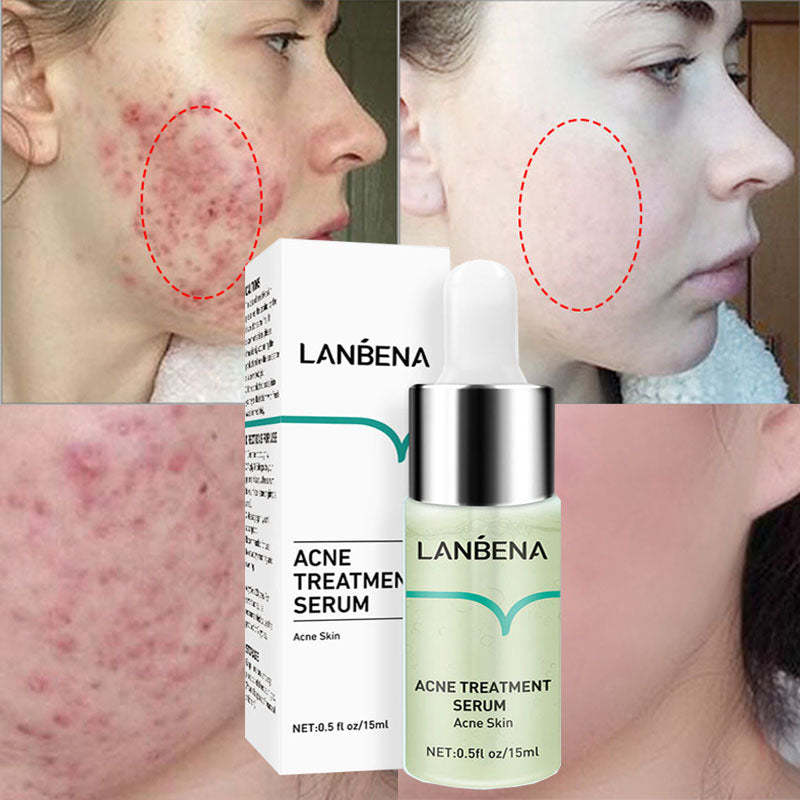 LANBENA Acne Removal Serum Salicylic Acid Anti-Acne Repair Fade Acne Spots Pimpl