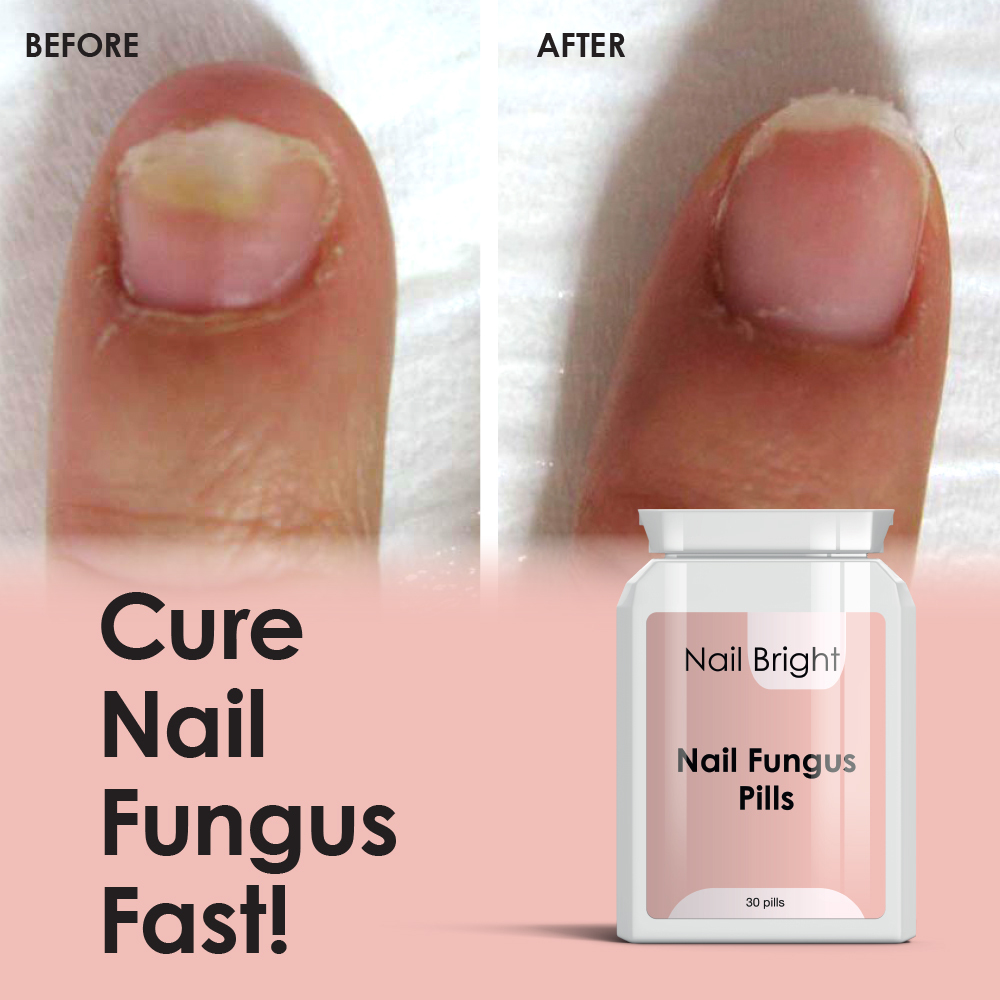 NAIL BRIGHT PILLS NAIL FUNGAL CURE STOP FUNGUS DRY BRITTLE CRUMBING