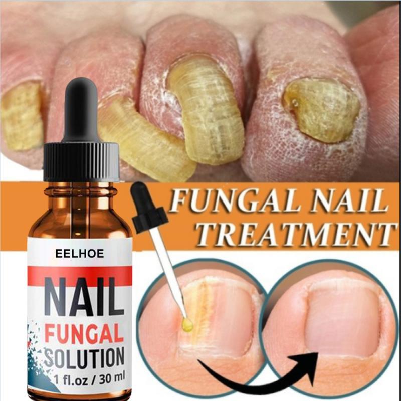 30ml Fungal Nail Repair Essence Serum Care Treatment Foot Nail Fungus Removal Ge