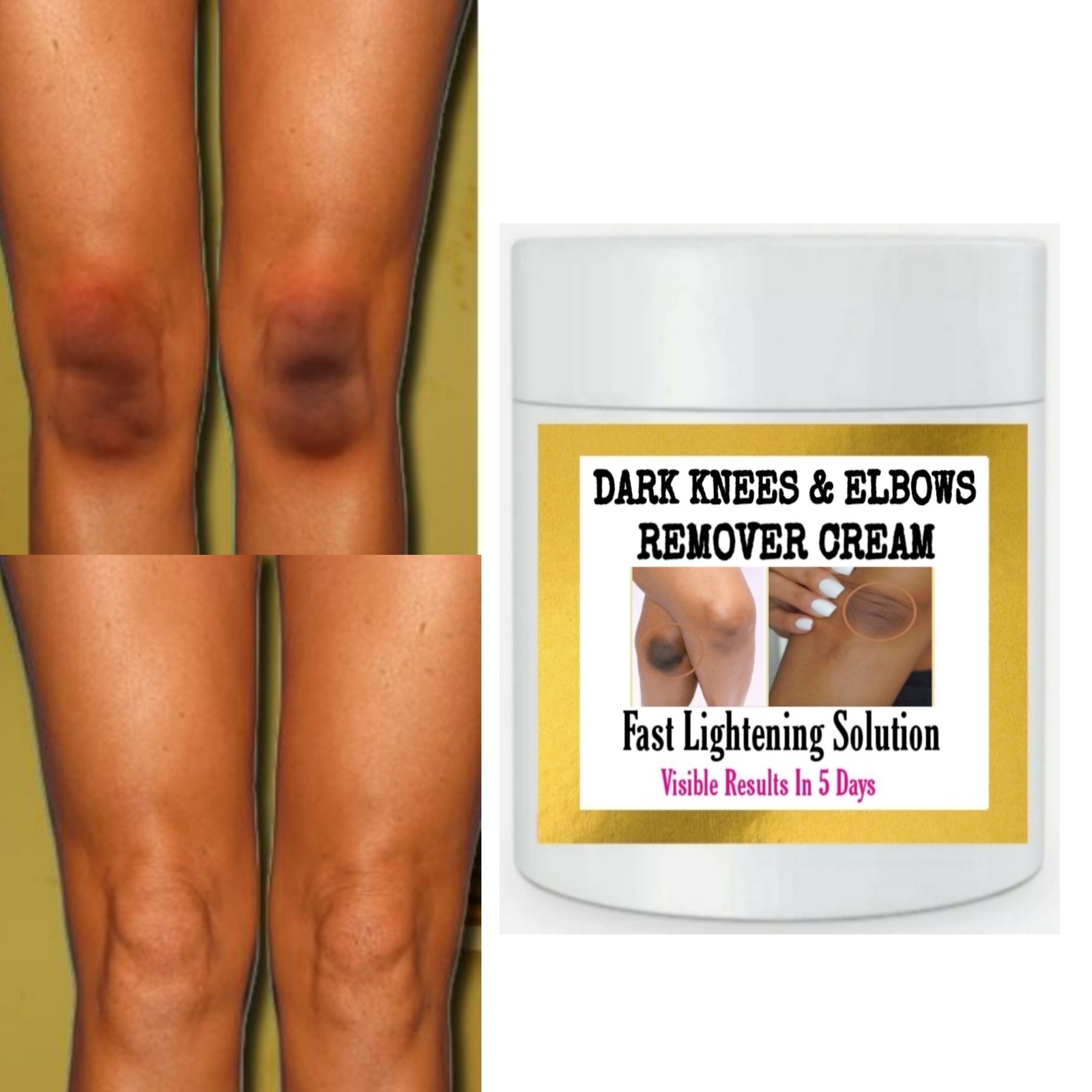 Dark knees and elbows eraser cream, dark spots remover cream
