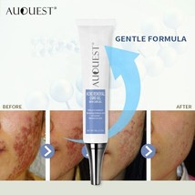 Acne Treatment Face Cream Acne Removal Gel Remove Pimple Skin Repair Cream - $7.91