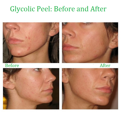 glycolic acid scars chemical wrinkles