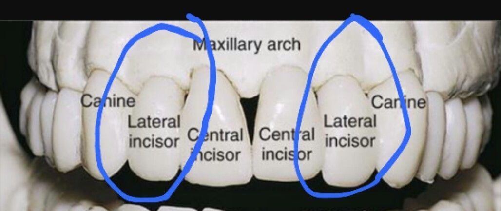 *DIY*Fake Tooth*New Temporary Replacement Front Tooth*Lateral Incisor ...