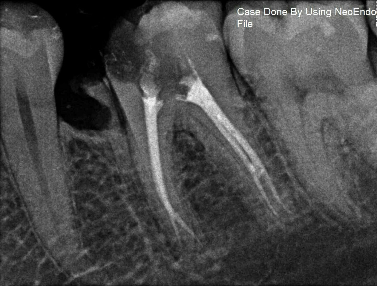 Neoendo Flex Files 21mm 6 30 Cross Section Triangular Rust Free