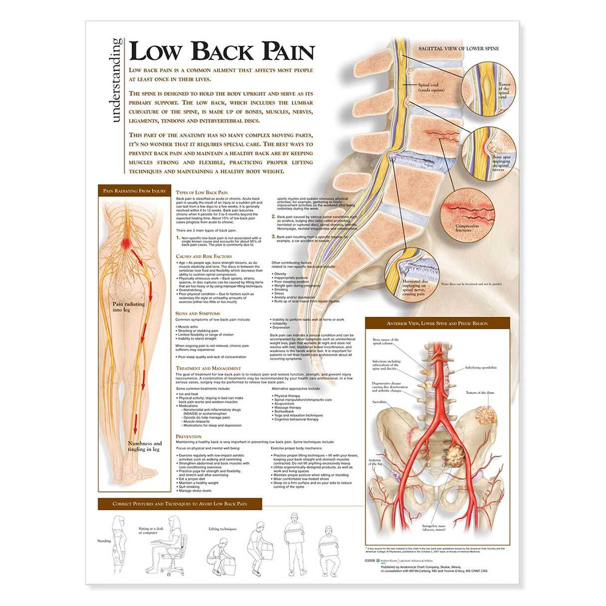 understanding-low-back-pain-anatomical-chart-laminated-teaching-education-supplies